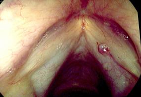 Right hemorrhagic vocal cord polyp