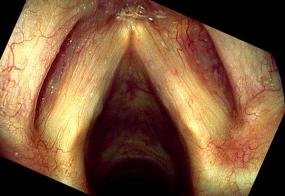 Hemorrhagic vocal cord polyp, healing one week after surgery