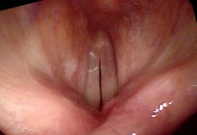 Hemorrhagic vocal cord polyp