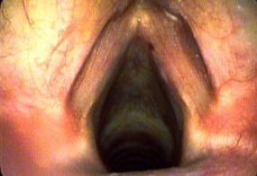 Hemorrhagic vocal cord polyp on right vocal cord margin