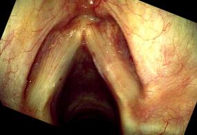 Hemorrhagic vocal cord polyp two weeks after excision
