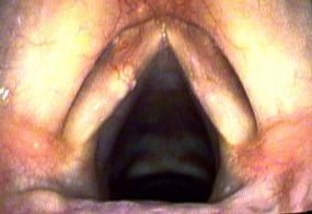 cyst within the left vocal cord, beneath the mucosa