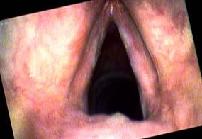 Vocal cord leukoplakia in a smoker with false color imaging