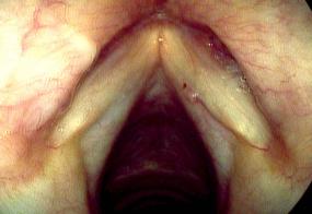 The hemorrhagic vocal cord polyp has either shrunk or fallen off and a new polyp formed