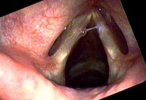 Hemorrhagic vocal cord polyp on the left side with secretions sticking on the right