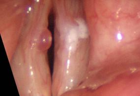  Laryngeal stroboscopy taken during open phase