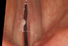 Hemorrhagic vocal cord polyp two months after excision