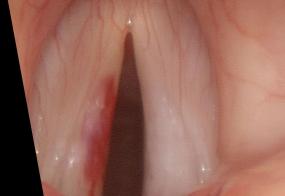 Low pitch with medial margin very visible during eversion