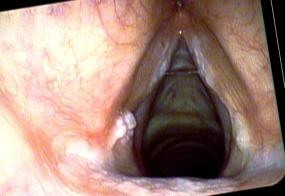 Central vocal cord leukoplakia and left vocal process granuloma