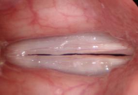 Vocal nodules or vocal calluses viewed during stroboscopy at high pitch