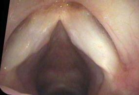 Hemorrhage into a vocal polyp on the left