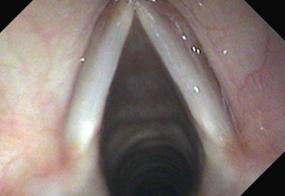 Normal Larynx - 25 year old female