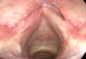 Tuberculosis of the larynx