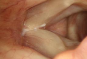 Anterior commissure detachment of vocal cords