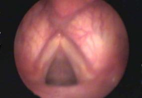 ADducted vocal folds