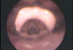 ABducted vocal folds