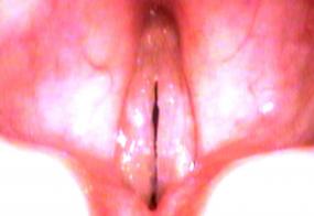 Amyloidosis of the vocal cords during stroboscopy