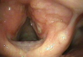 Amyloid deposits in the false vocal cords