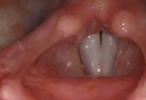 Normal female vocal cords