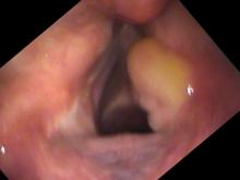 Vocal cord granuloma