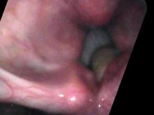 Vocal cord granuloma