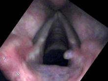 Vocal cord granuloma