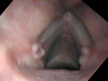 Vocal cord granulomas