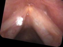 Leukoplakia - verrucous keratosis