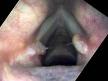 Vocal cord granulomas