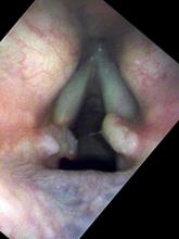 Vocal cord granulomas