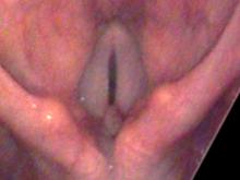 Vocal cord granulomas