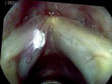 Leukoplakia - verrucous keratosis