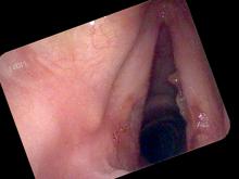 chronic bacterial laryngitis