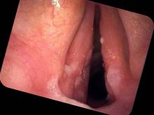 chronic bacterial laryngitis