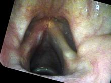 verrucous keratosis lesion one month after excision