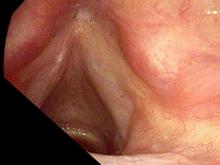 verrucous keratosis lesion two months after excision