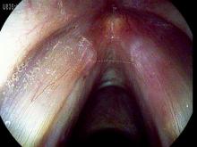 Bilateral vocal nodules viewed with false color imaging with a Pentax high definition endoscope