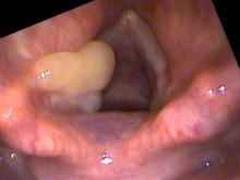 Vocal cord granulomas