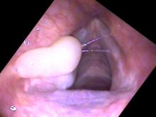 Vocal cord granulomas