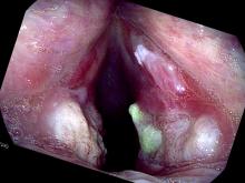 close-up of vocal cord ulcerations after and in a tracheal intubation for 5 days