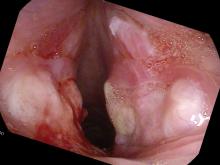 vocal cord ulcerations