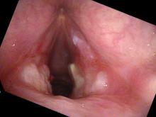 vocal cord ulcerations