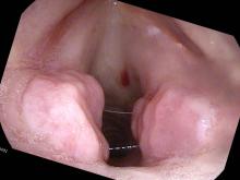 granulomas are developing at the site of the vocal cord ulcerations