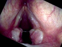 vocal cord granulomas are beginning to mature on both sides and become more pedunculated