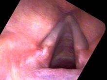 Vocal cord granulomas