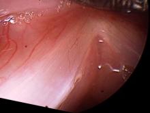 70° endoscopic surgical view of left vocal cord nodule after excision