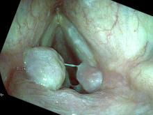 vocal cord granulomas - false color imaging