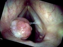 the right vocal cord granuloma has fallen off