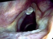 Hemorrhagic vocal cord polyp