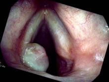 another granuloma fell off, only one remains on the left side